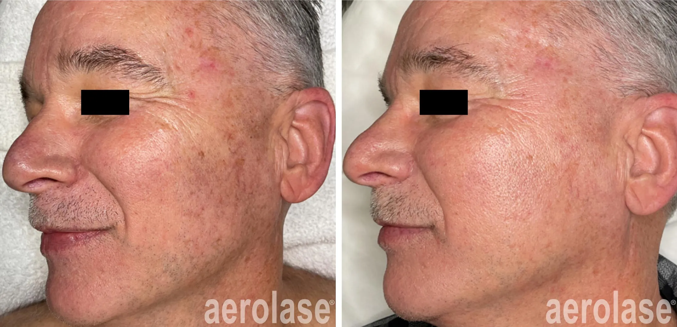 Skin rejuvenation
