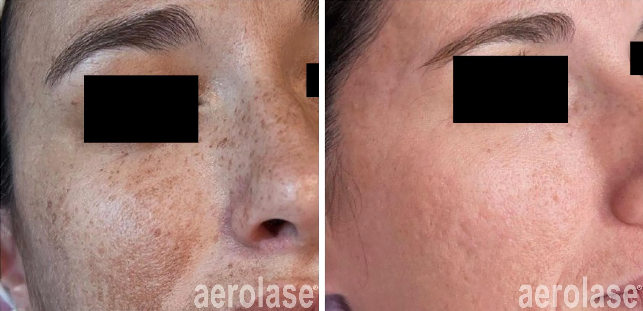 Melasma Treatment before and after