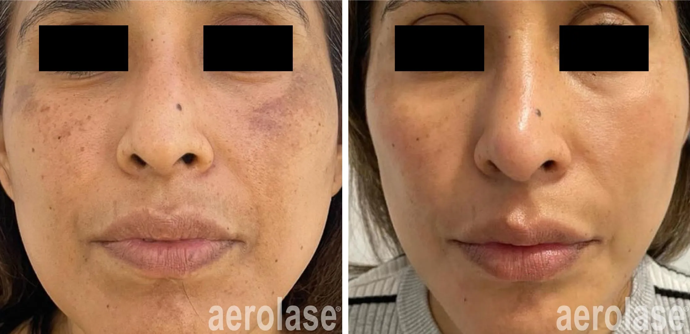 melasma treatment in Cairns