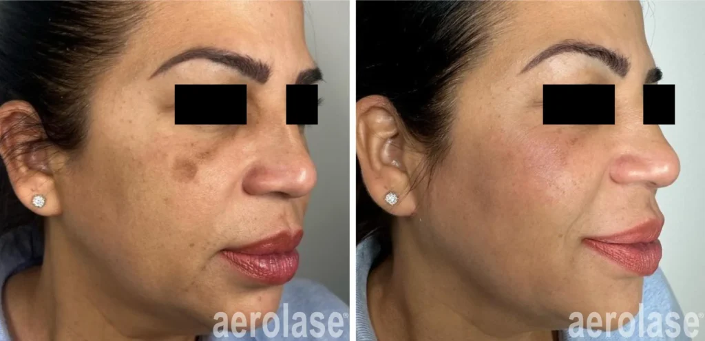 Best melasma treatment