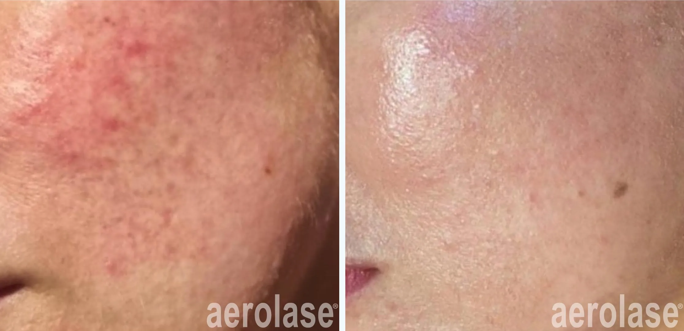 Rosacea-friendly skincare routine