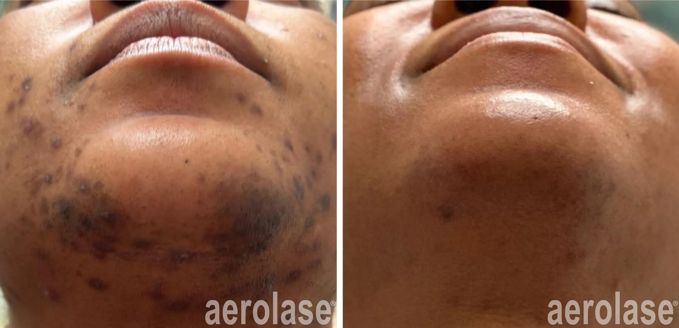 Pseudofolliculitis Barbae Treatment