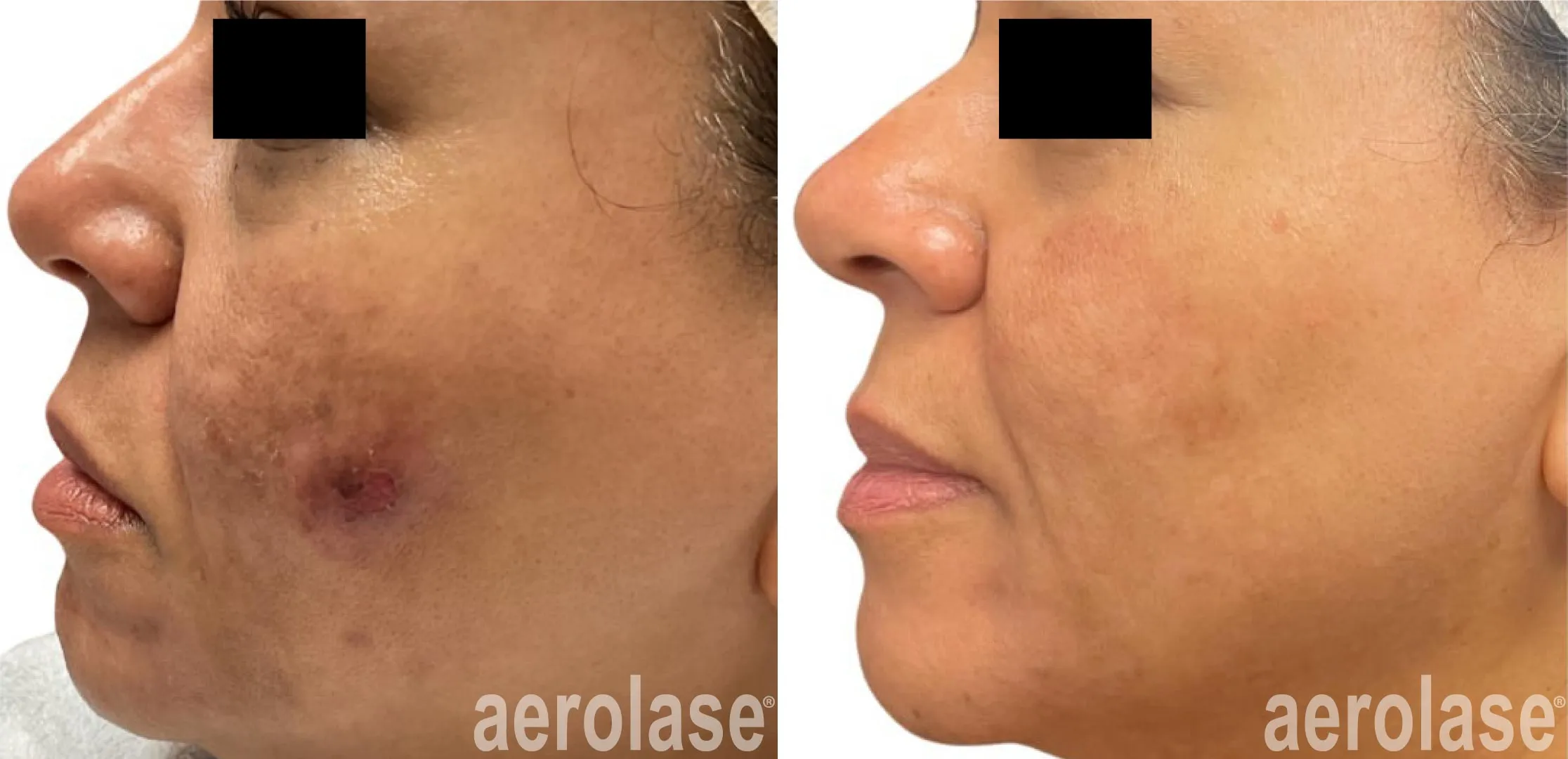 Non-invasive anti-ageing treatment