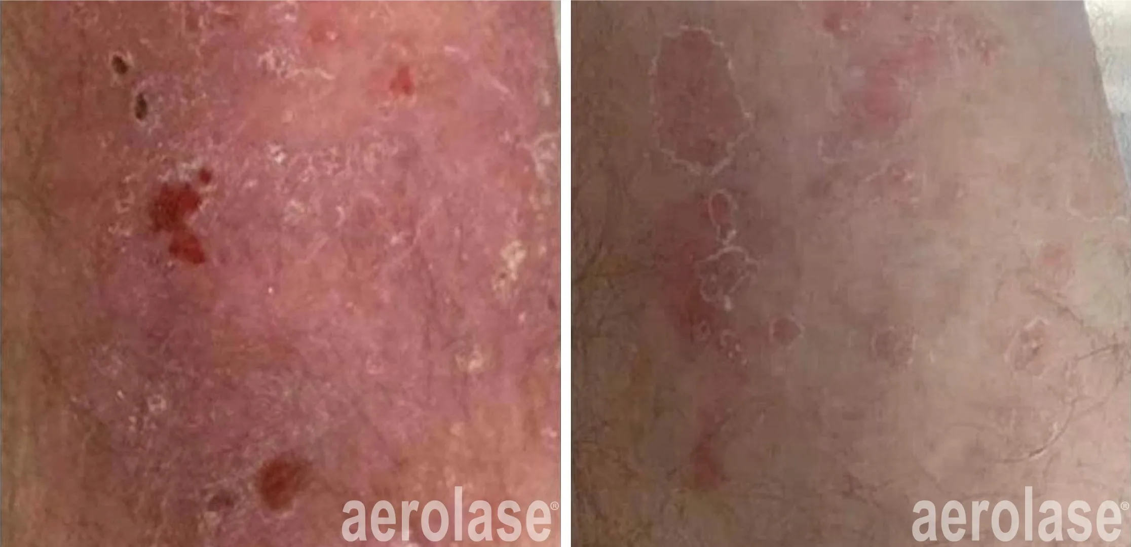 Psoriasis Treatment Cairns