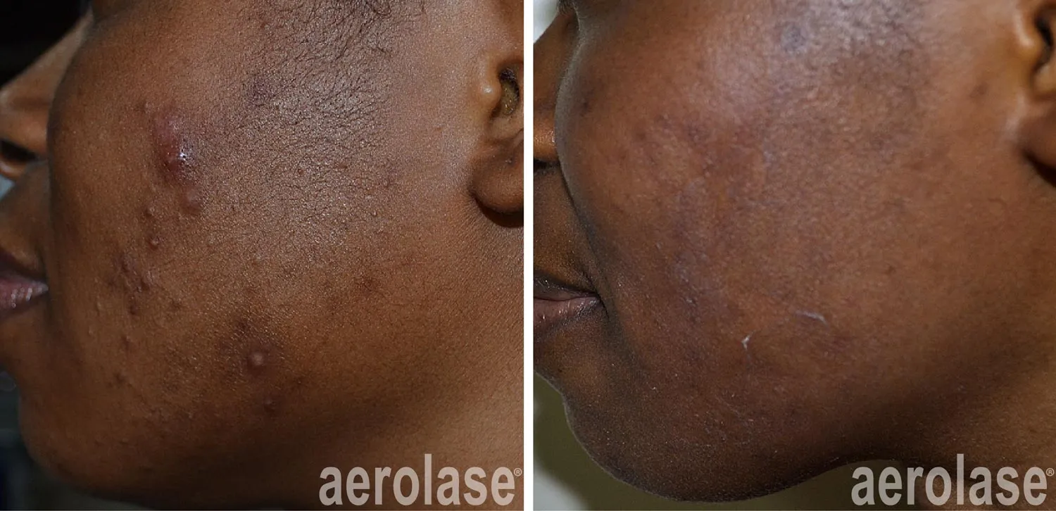acne blemishes before and after