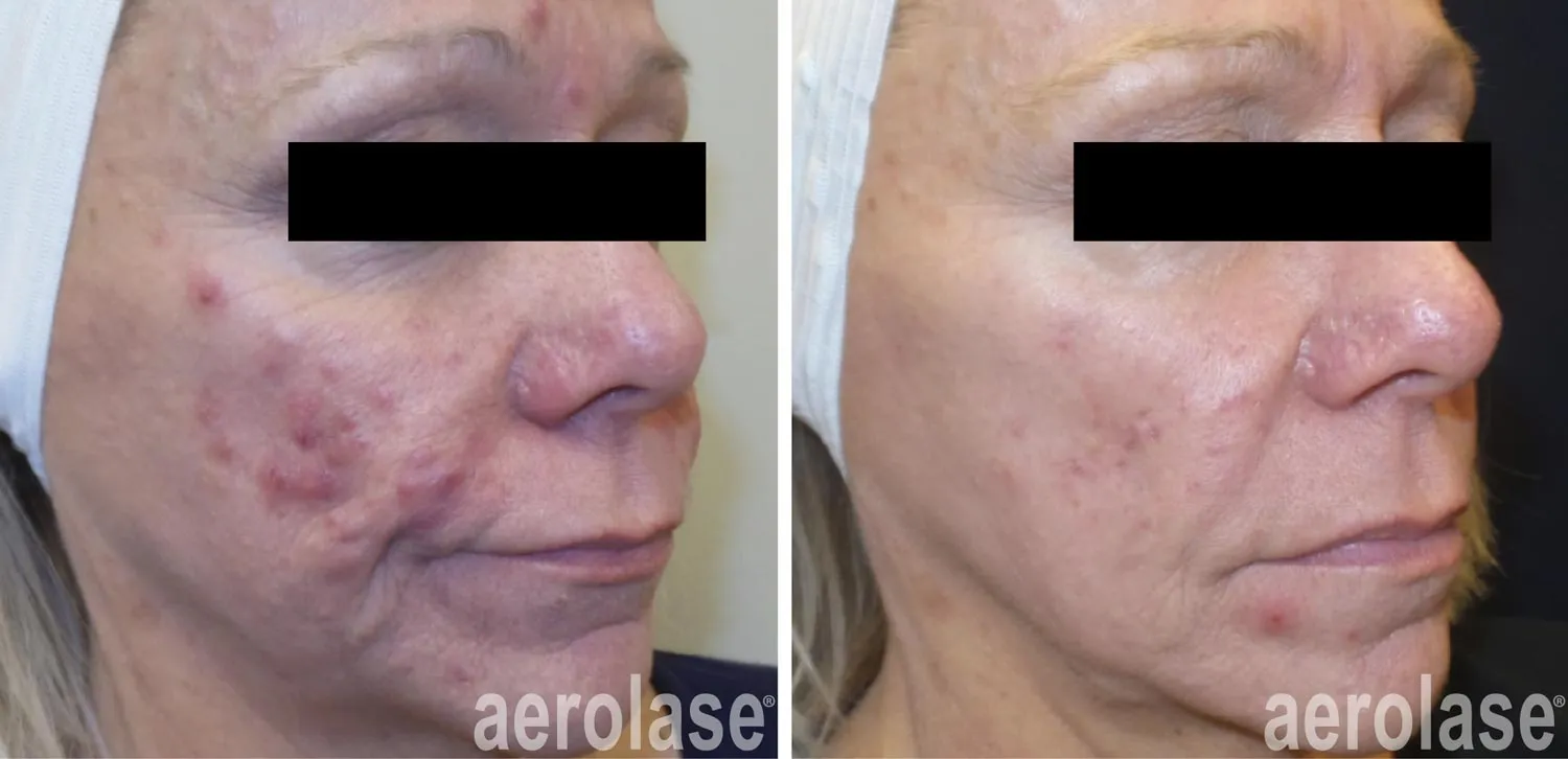 acne cystic before and after