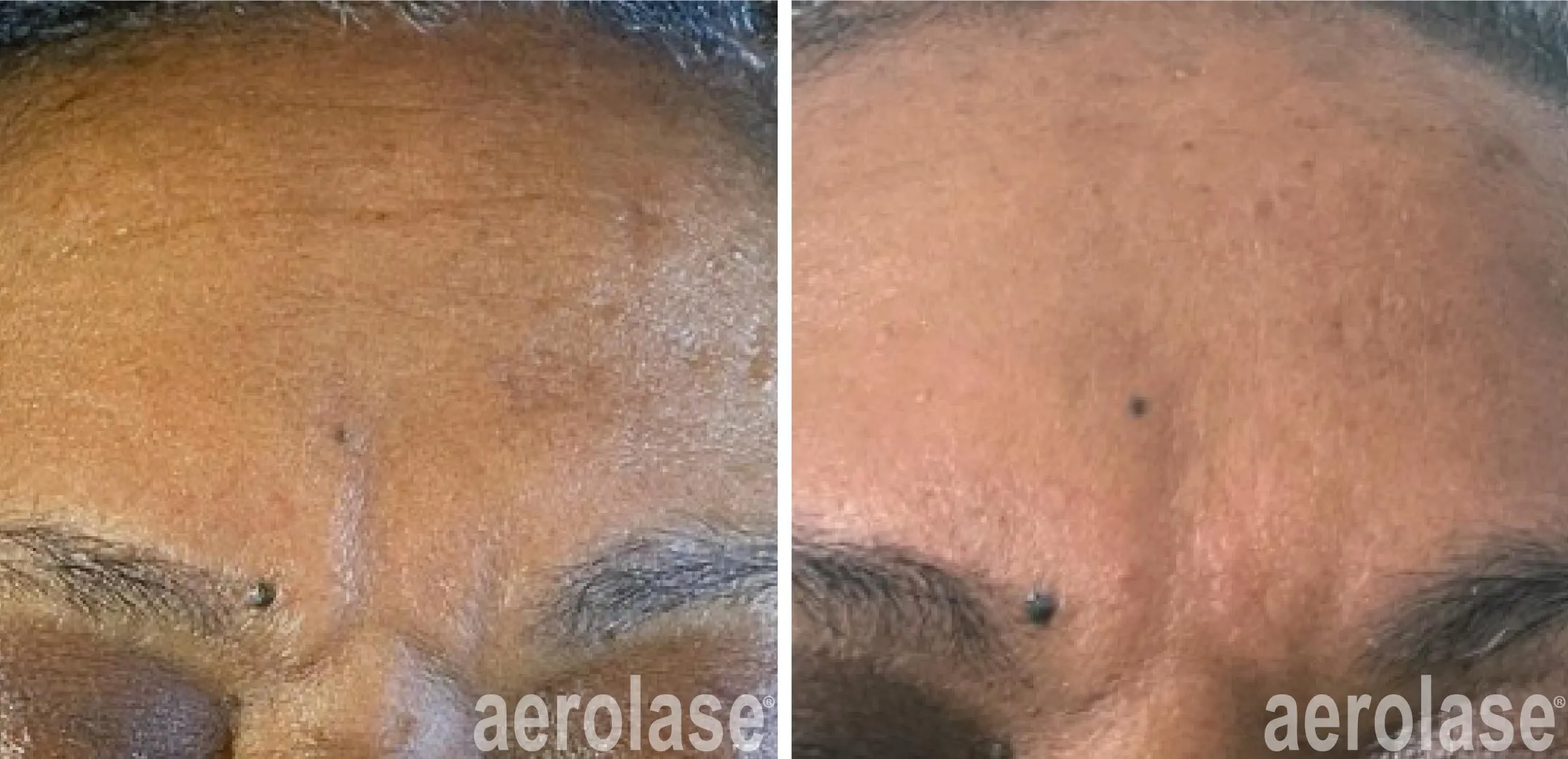 Anti ageing skin treatment