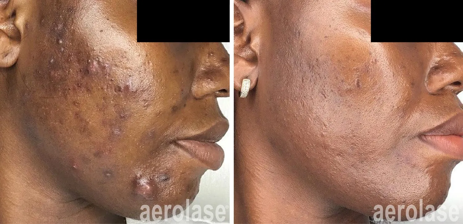 Idun Aesthetics acne treatment