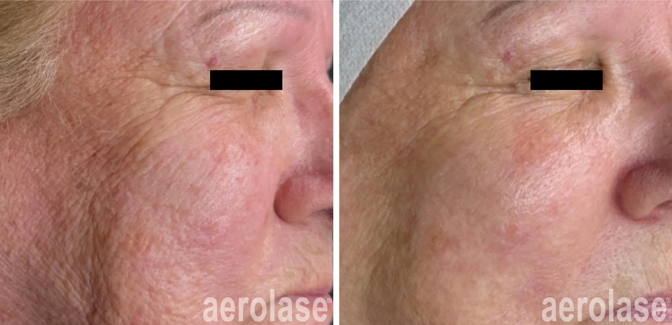 Skin rejuvenation in Cairns