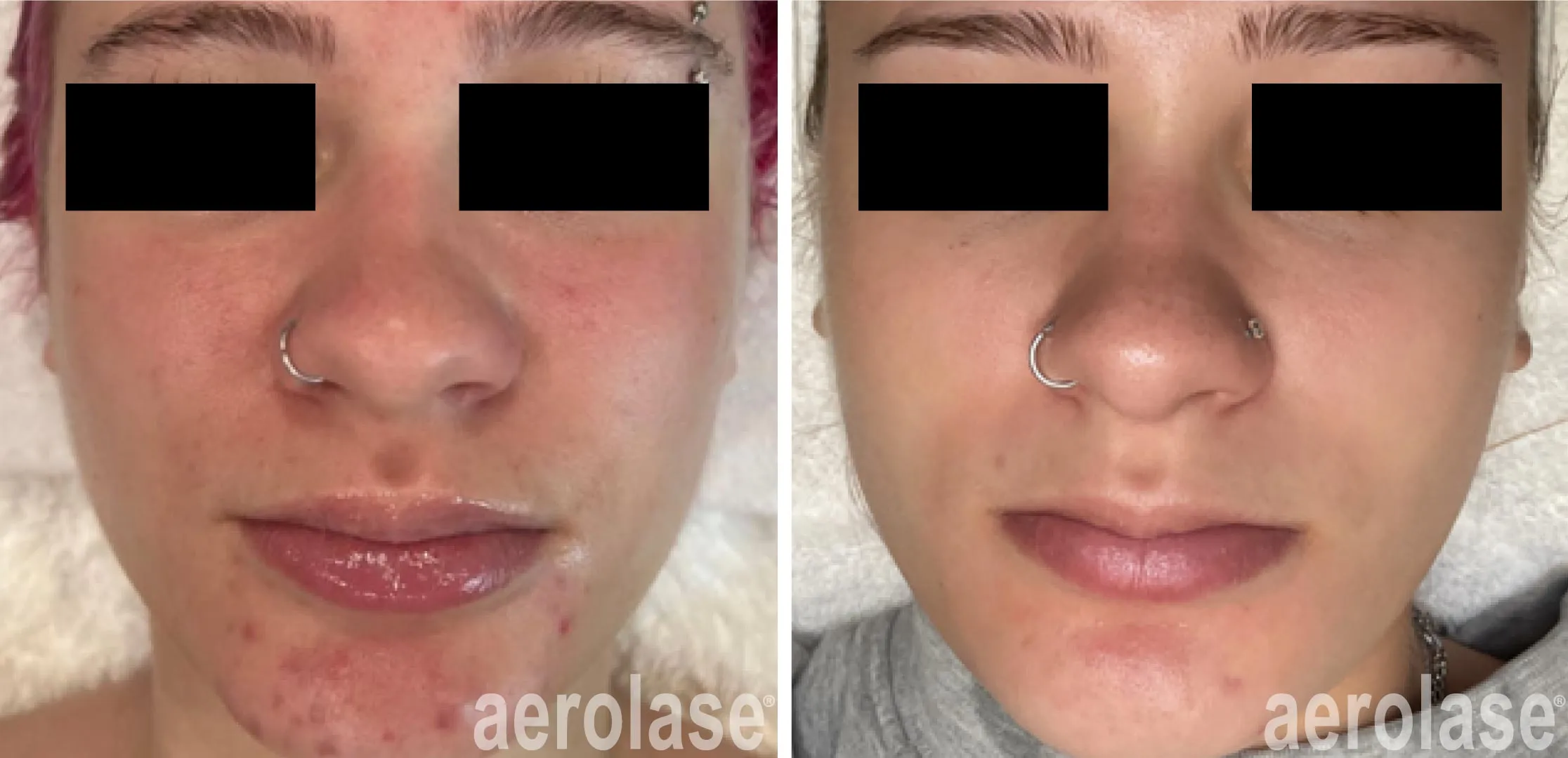 Skin needling for acne