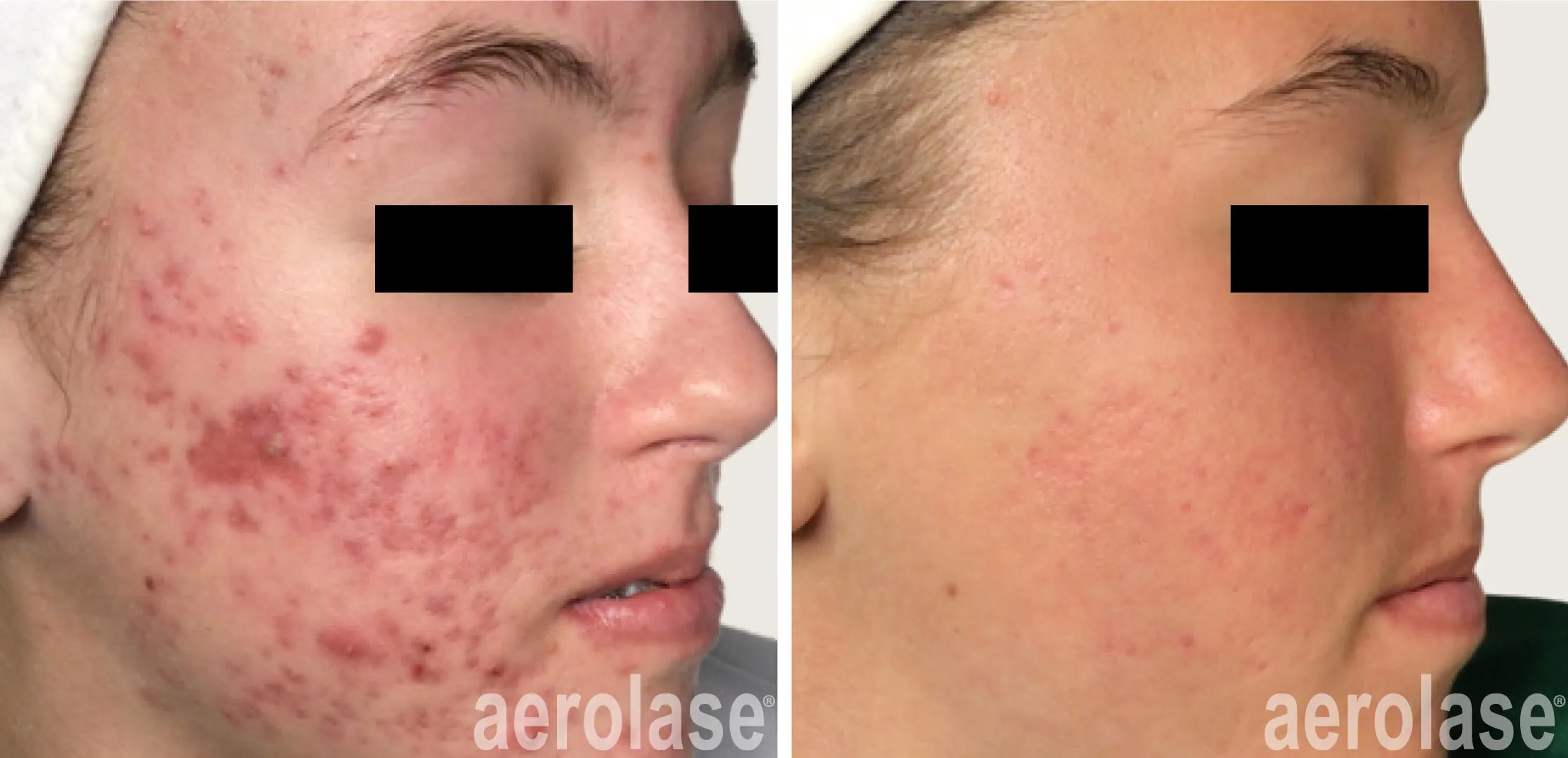 Eliminates Acne-Causing Bacteria & Regulates Oil Production