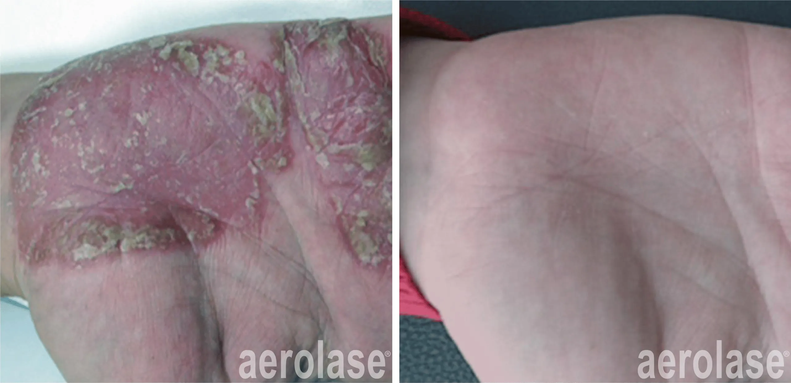 Treatment for Psoriasis