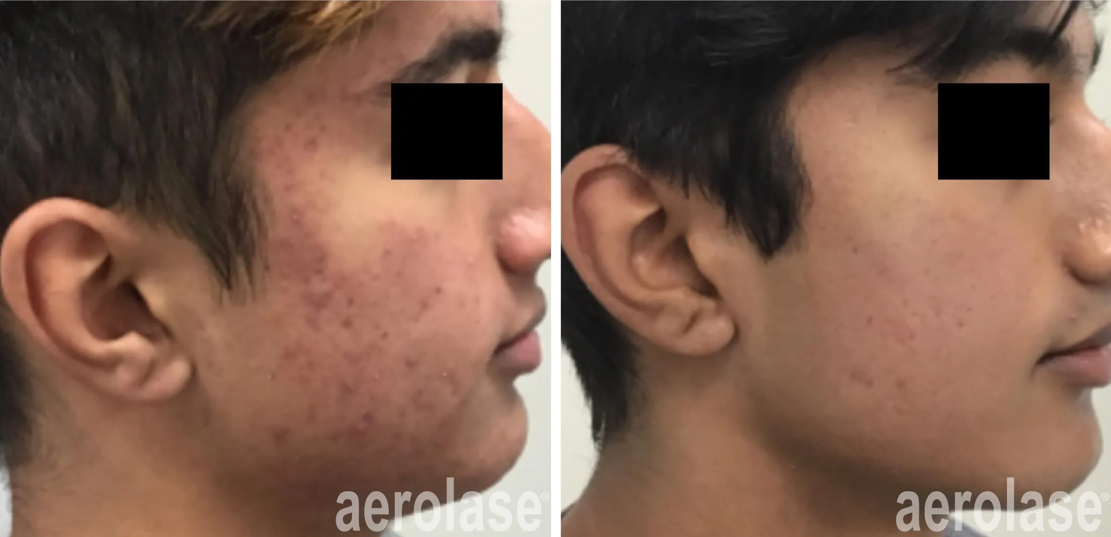 acne treatment result before and after