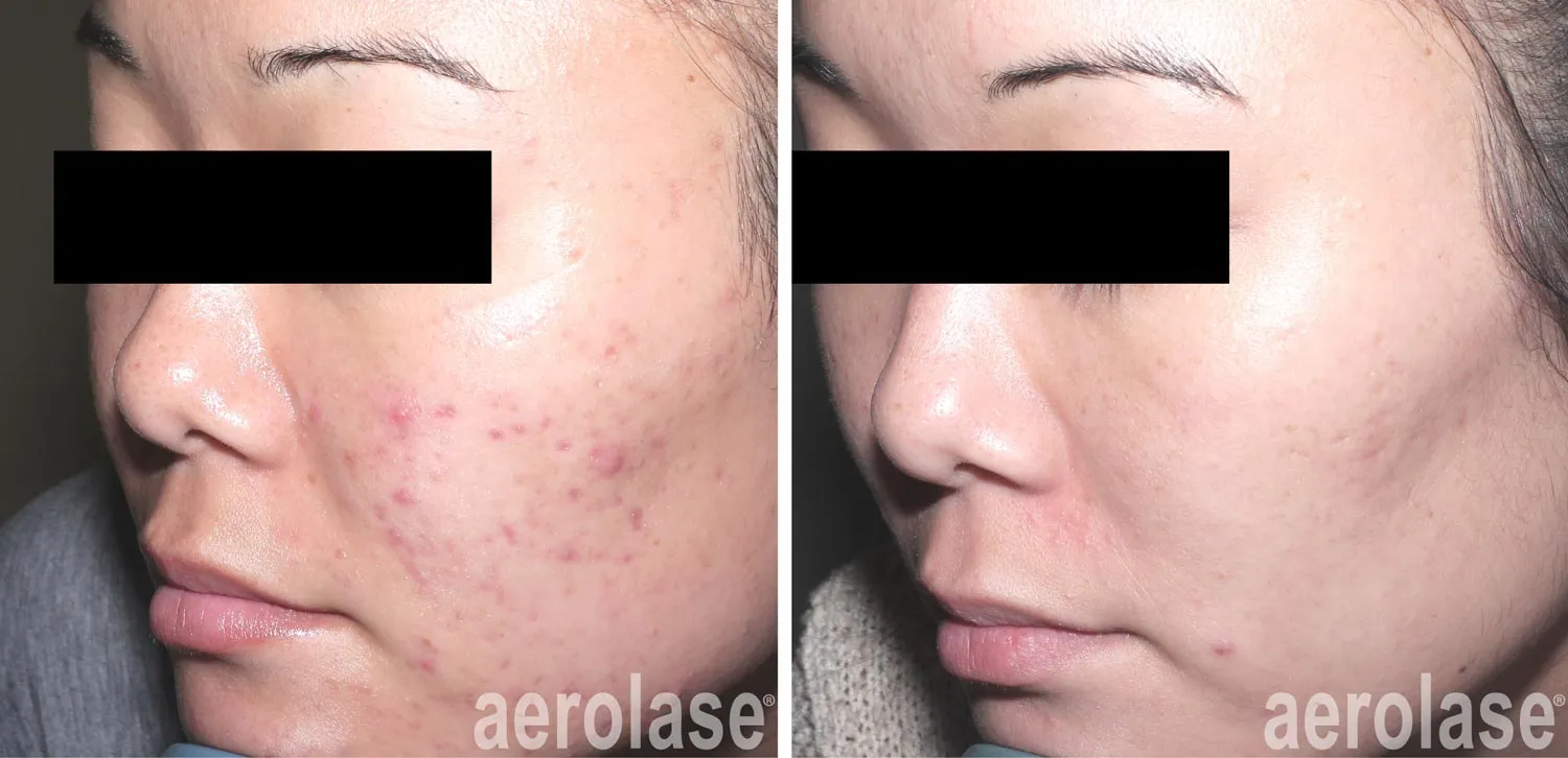 skincare treatment