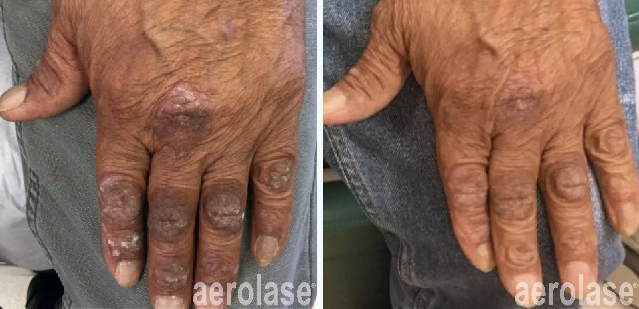Best Psoriasis Treatment