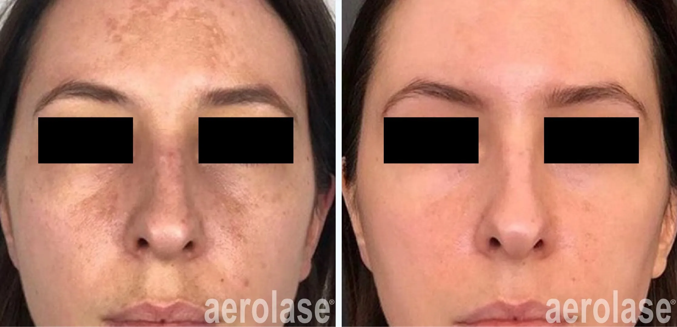 Melasma Treatment Idun Aesthetics