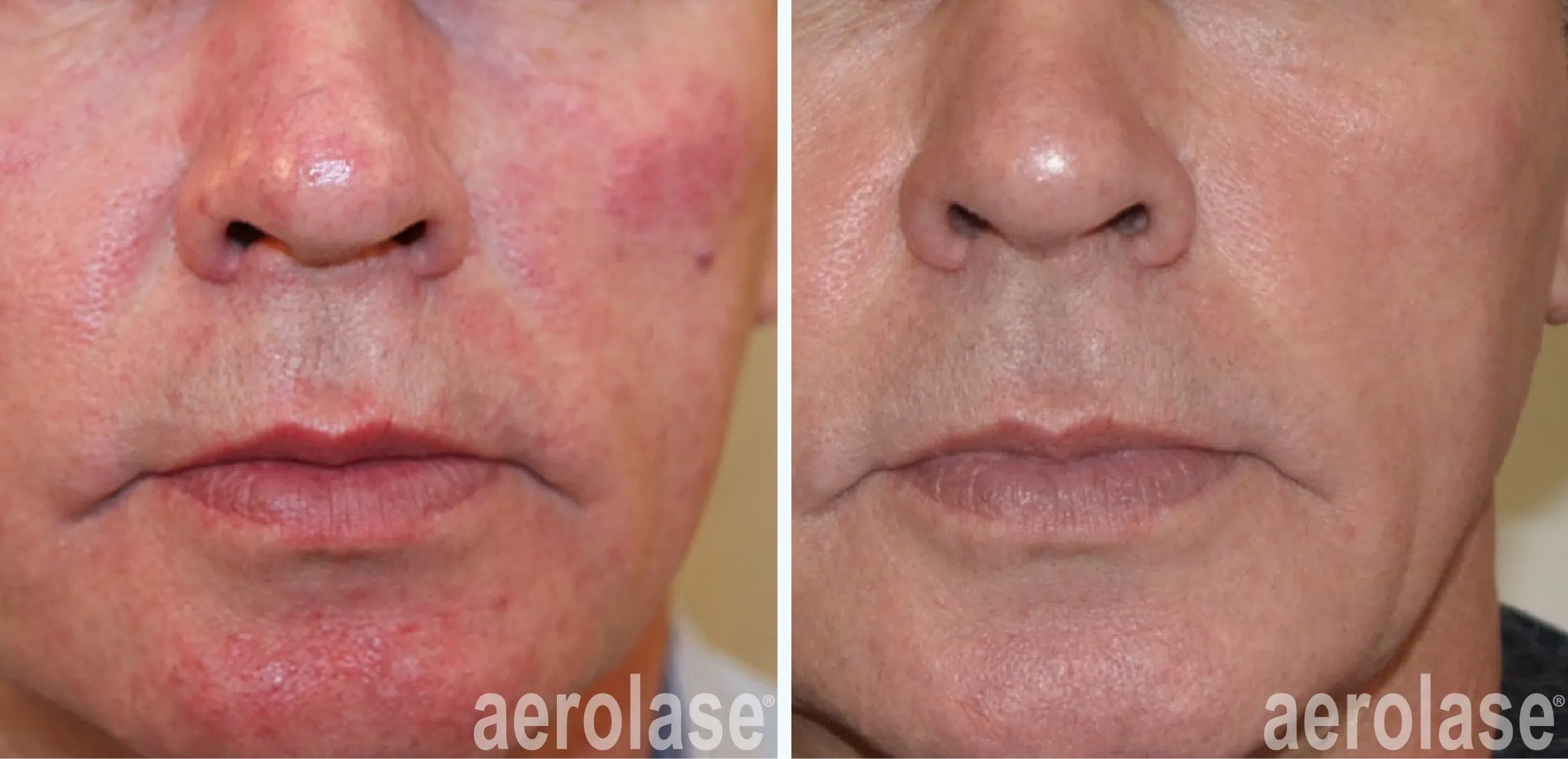 Rosacea before and after results