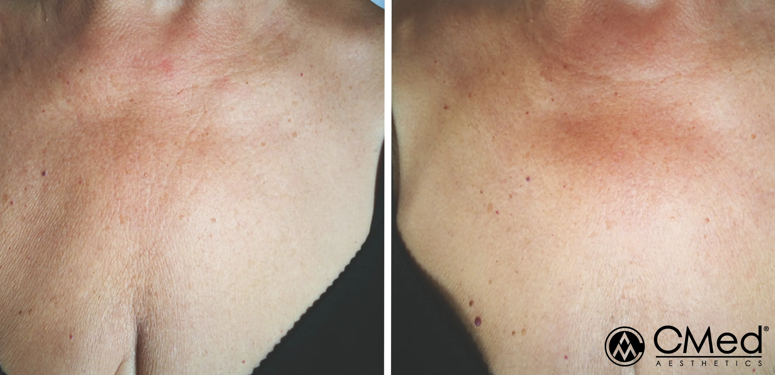 Before and After Biorepeel Treatment