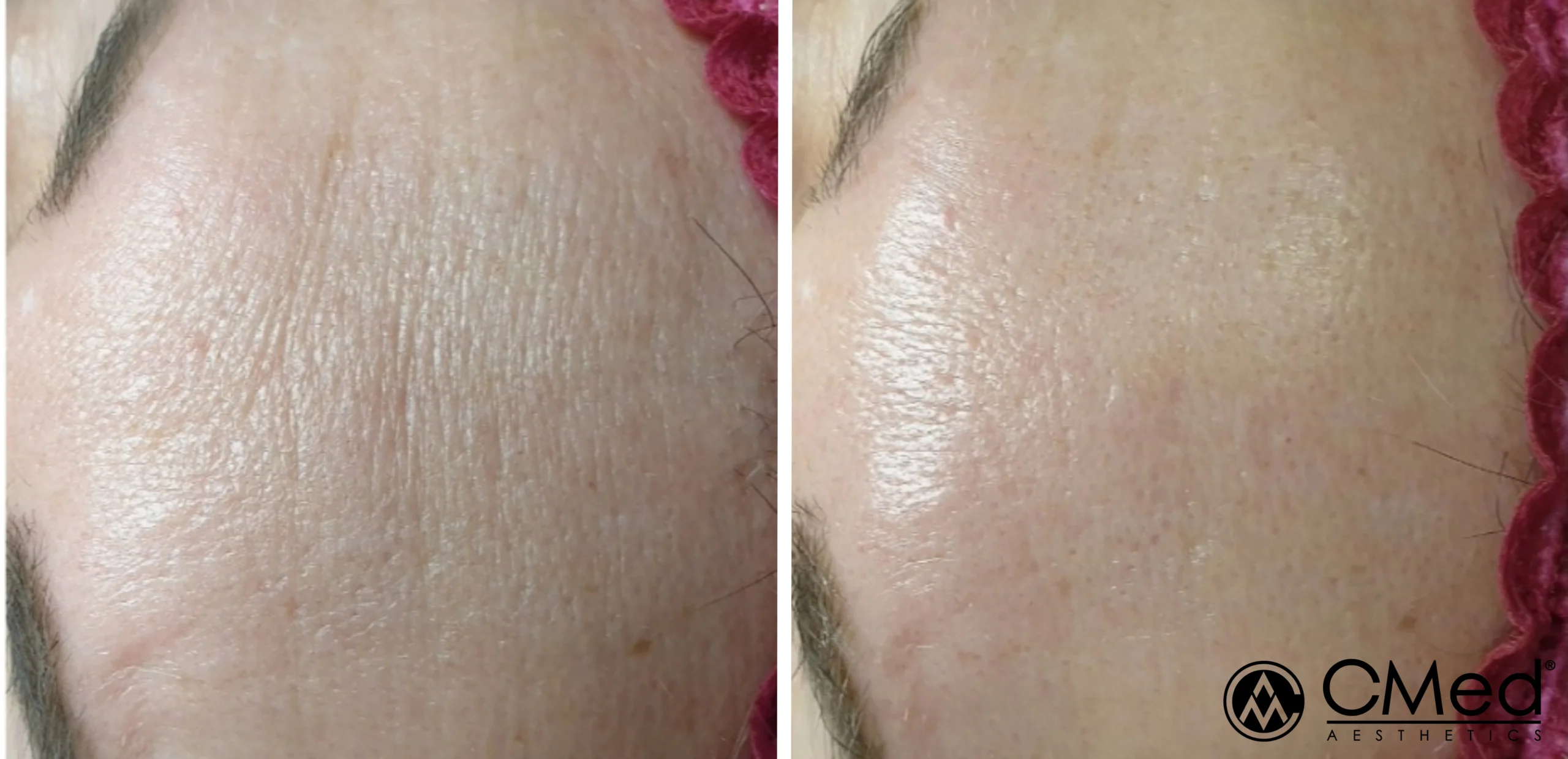 Biorepeel Treatment Cairns