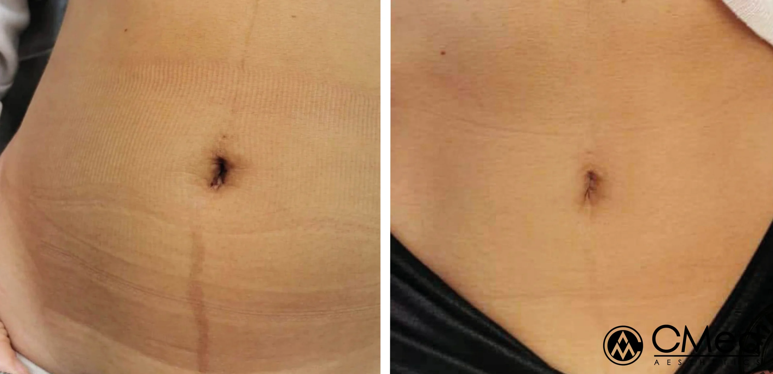 Before and After Biorepeel​