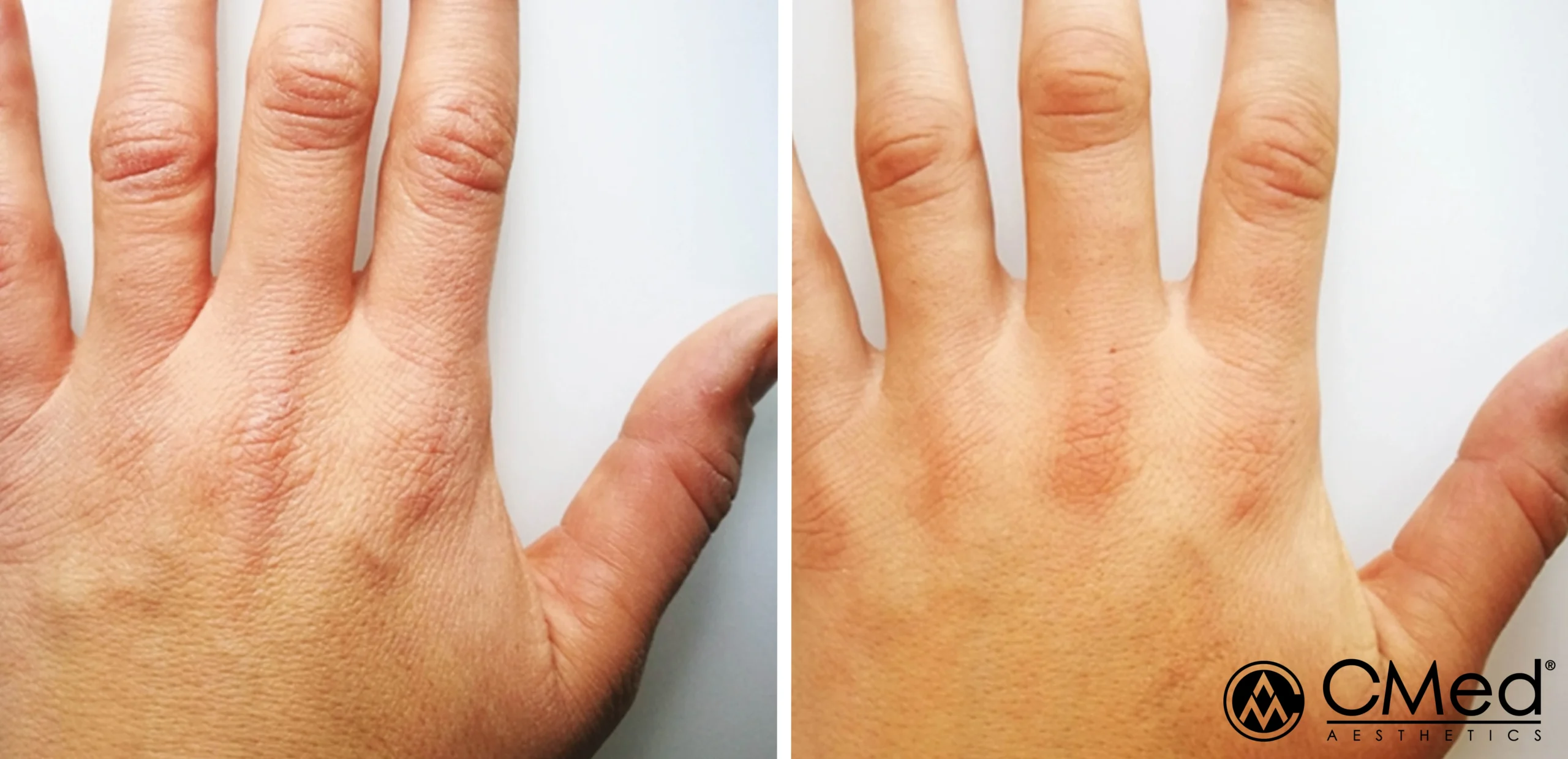 BioRePeel before and after