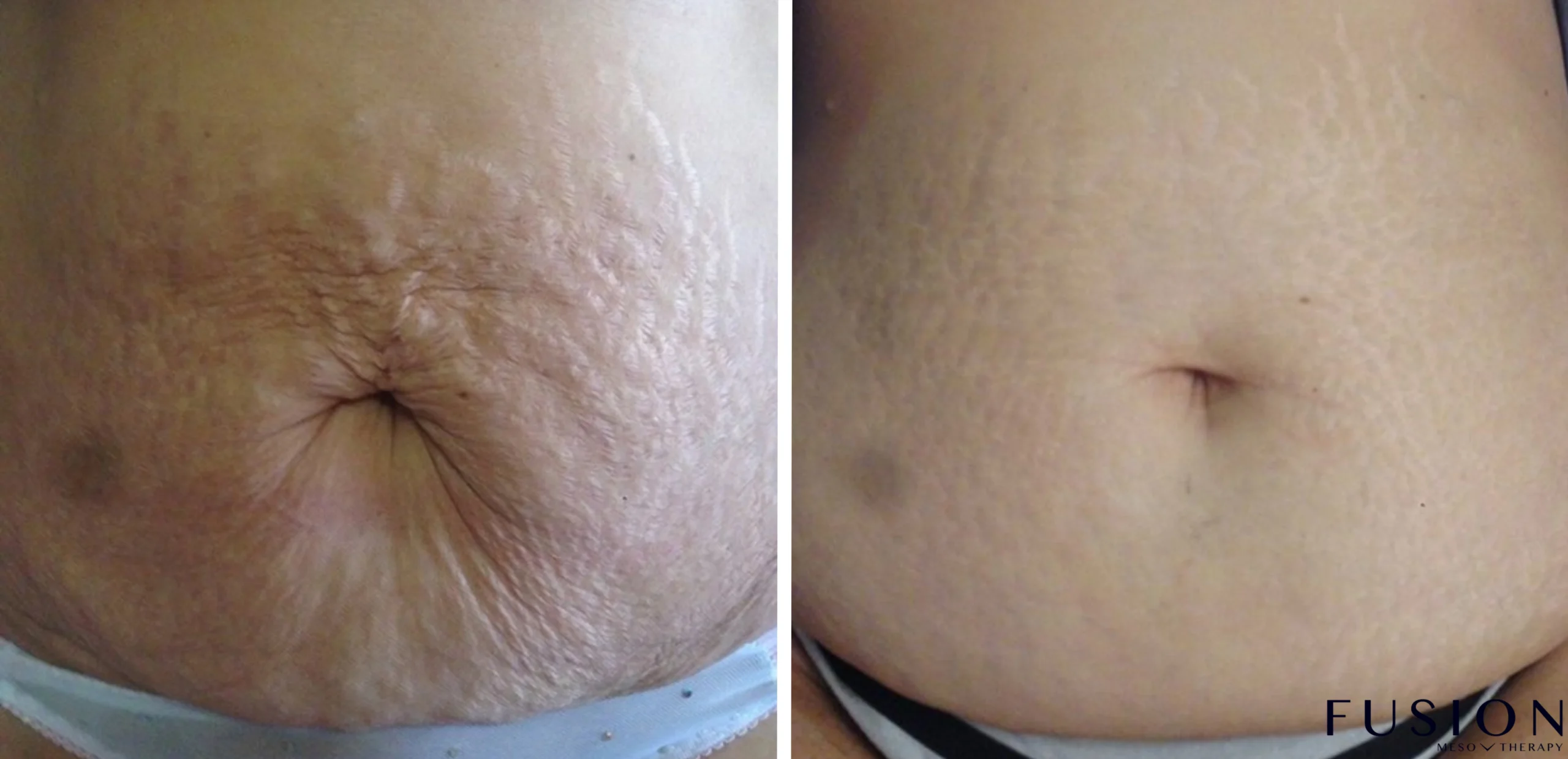 Fusion Meso Therapy Treatments