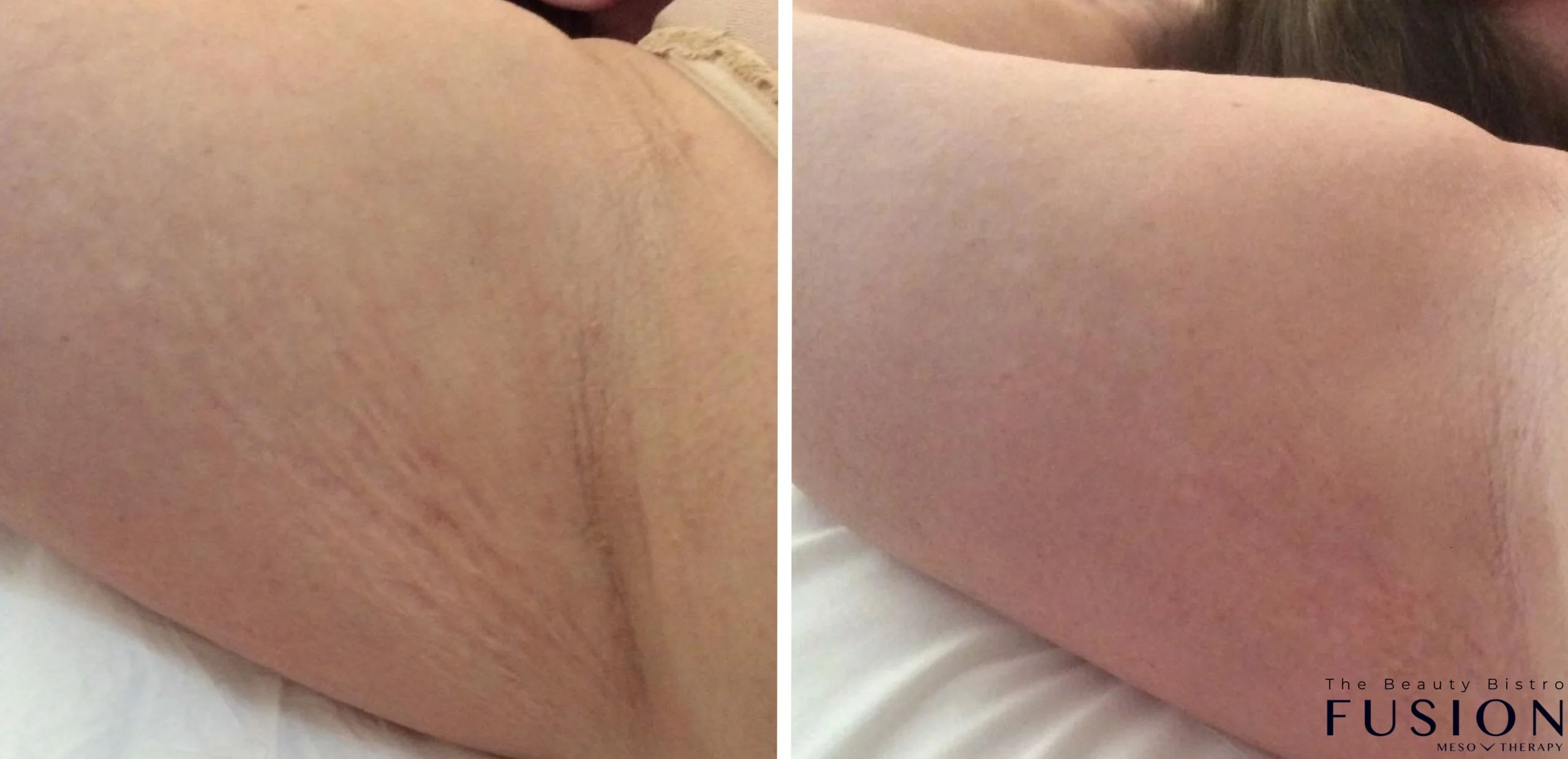 Meso Skin Treatment Cairns