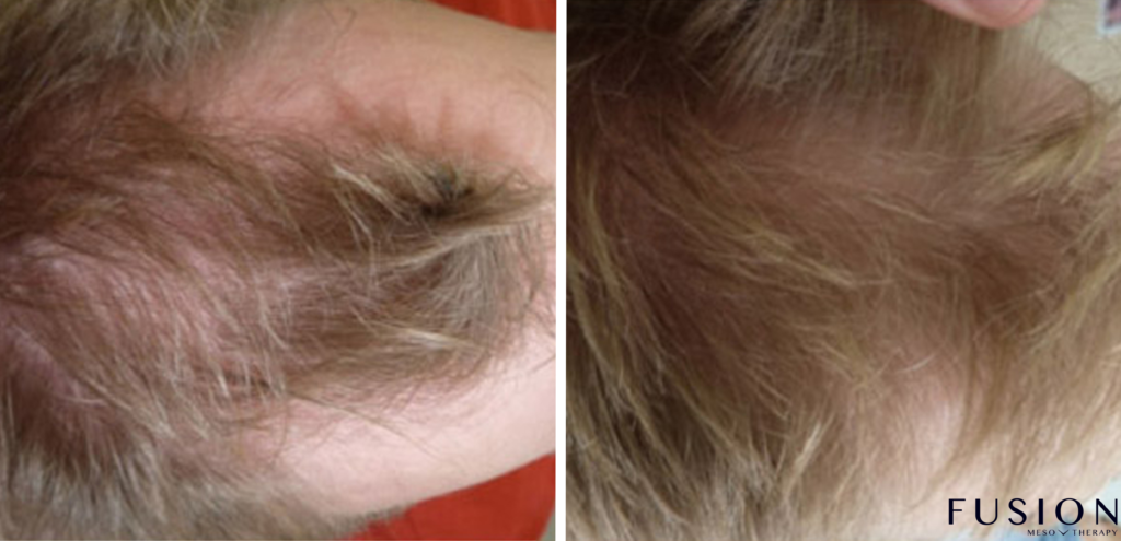 Hair Treatment for Hair Growth​