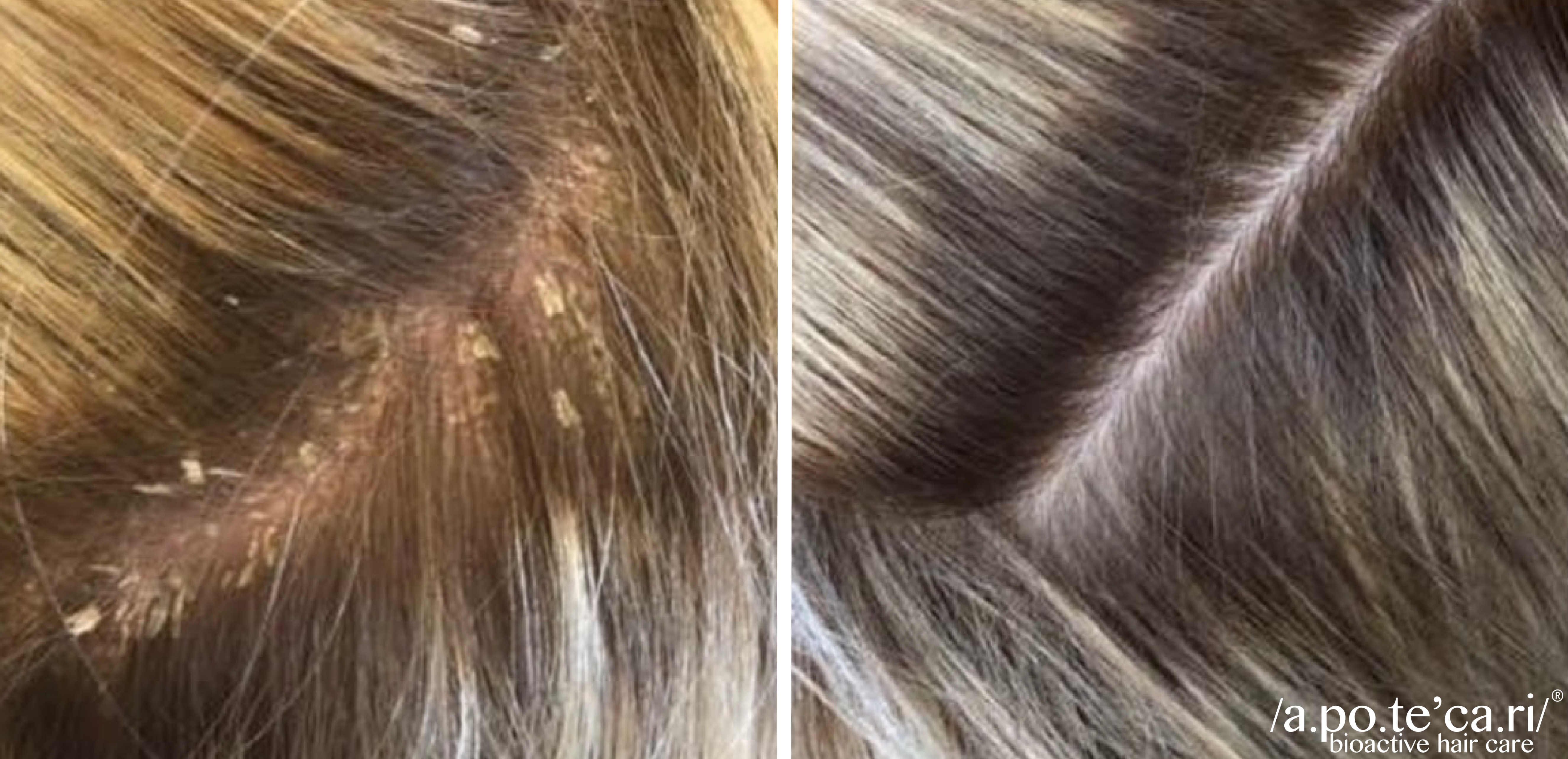 Hair Fall Treatment