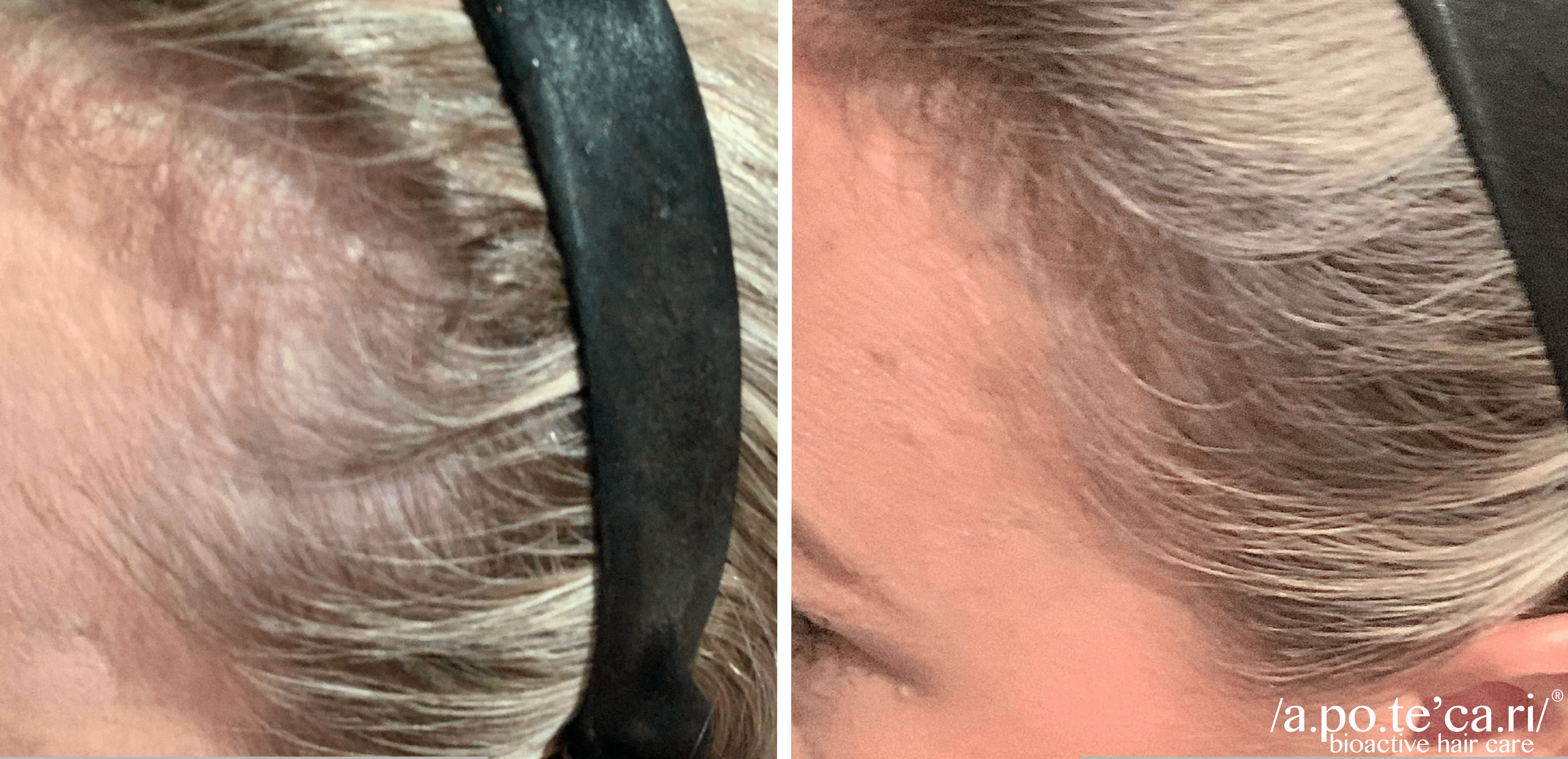 Hair Treatment for Hair Loss