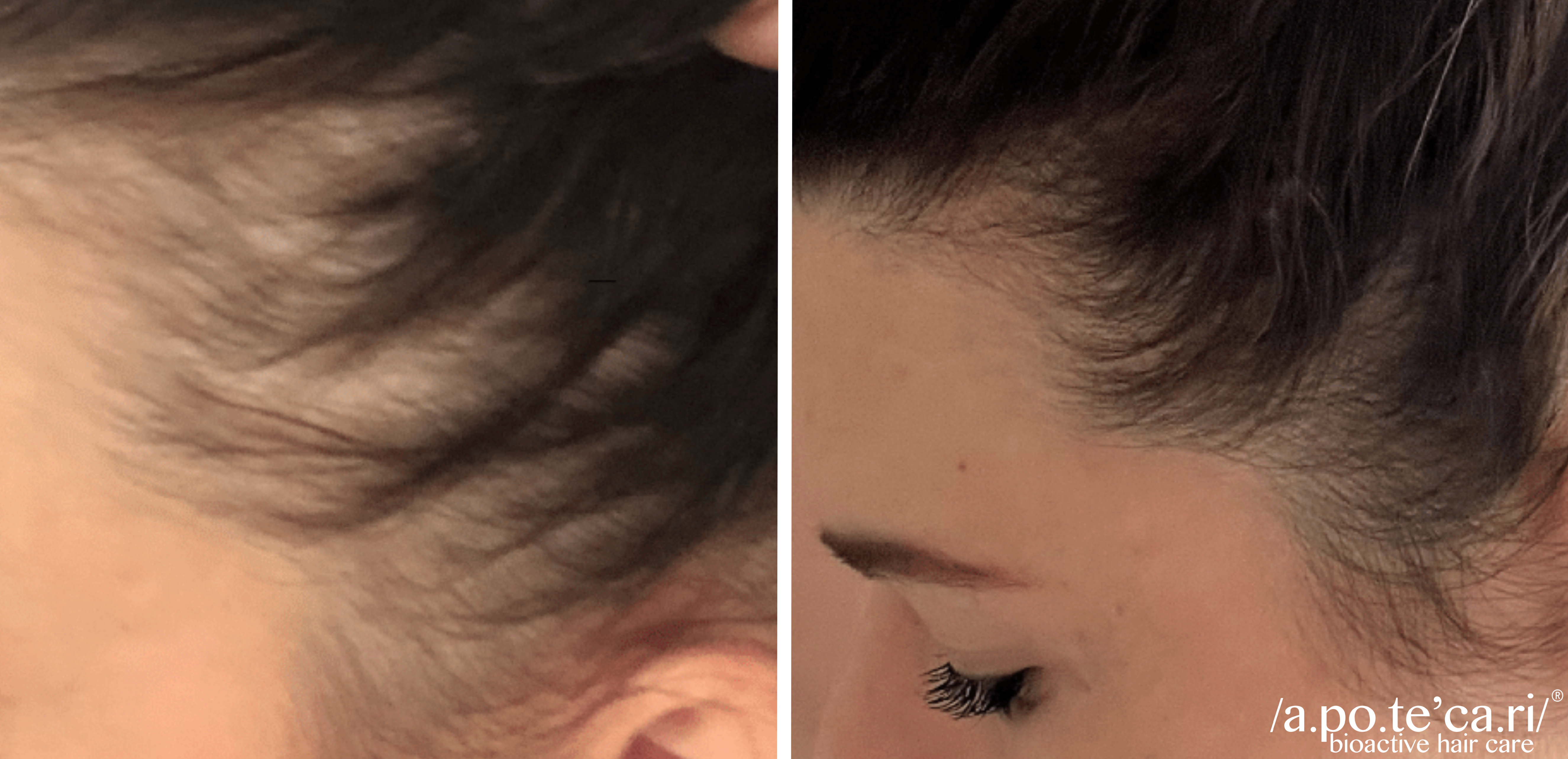 Hair Loss Baldness Treatment
