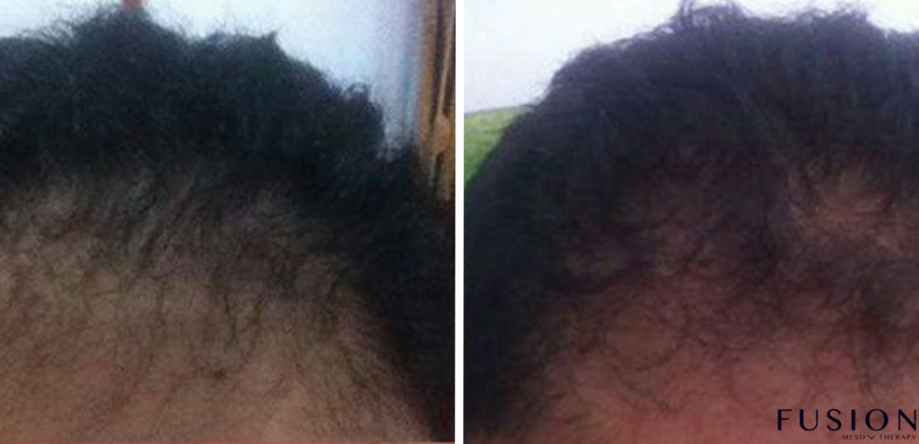 Hair Fall Treatment