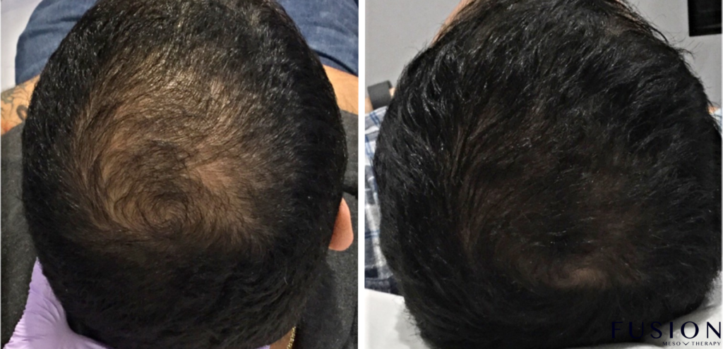 Hair Regrowth Treatment