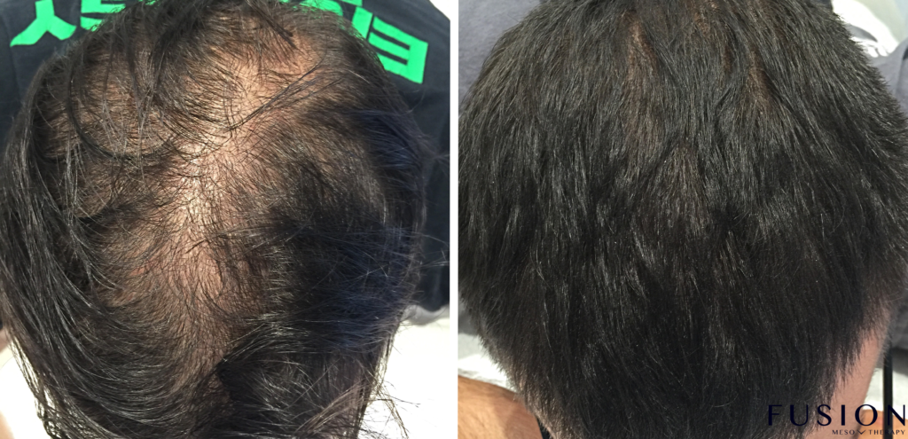Best Hair Treatment for Hair