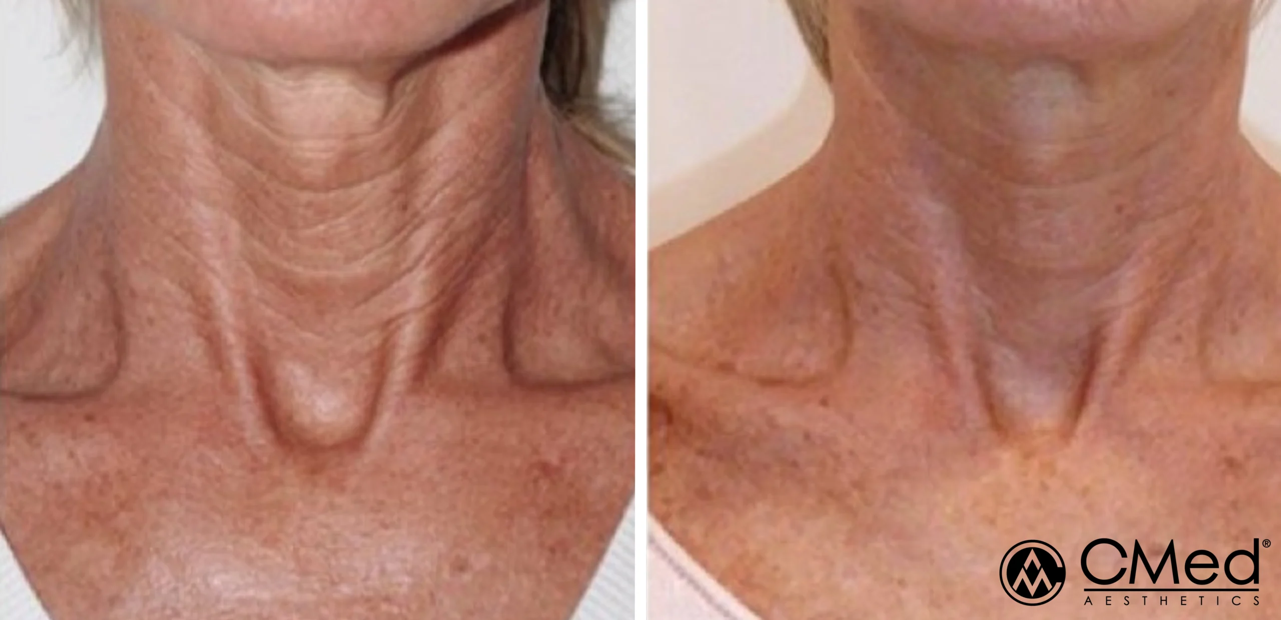 Biorepeel Aftercare​