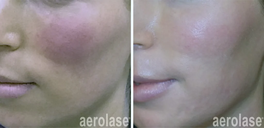 Reduces Redness & Clears Dilated Blood Vessels 