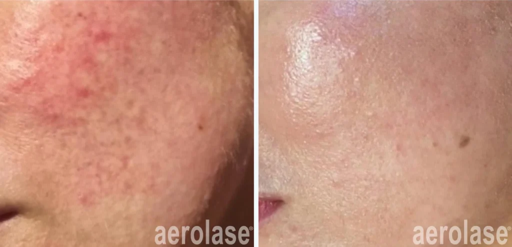 Supports Long-Term Skin Clarity
