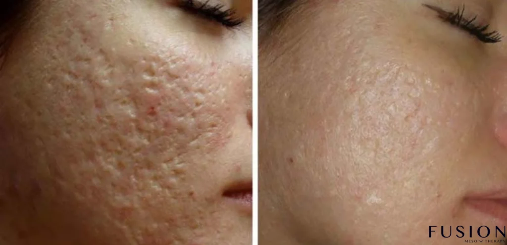 Micro needling Cairns