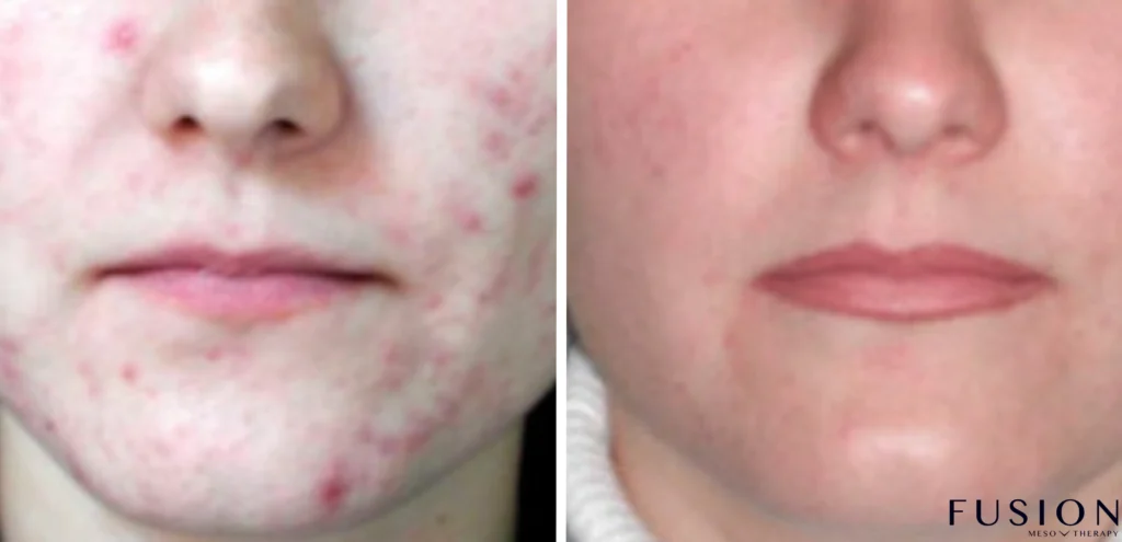 Nano Peel Cairns