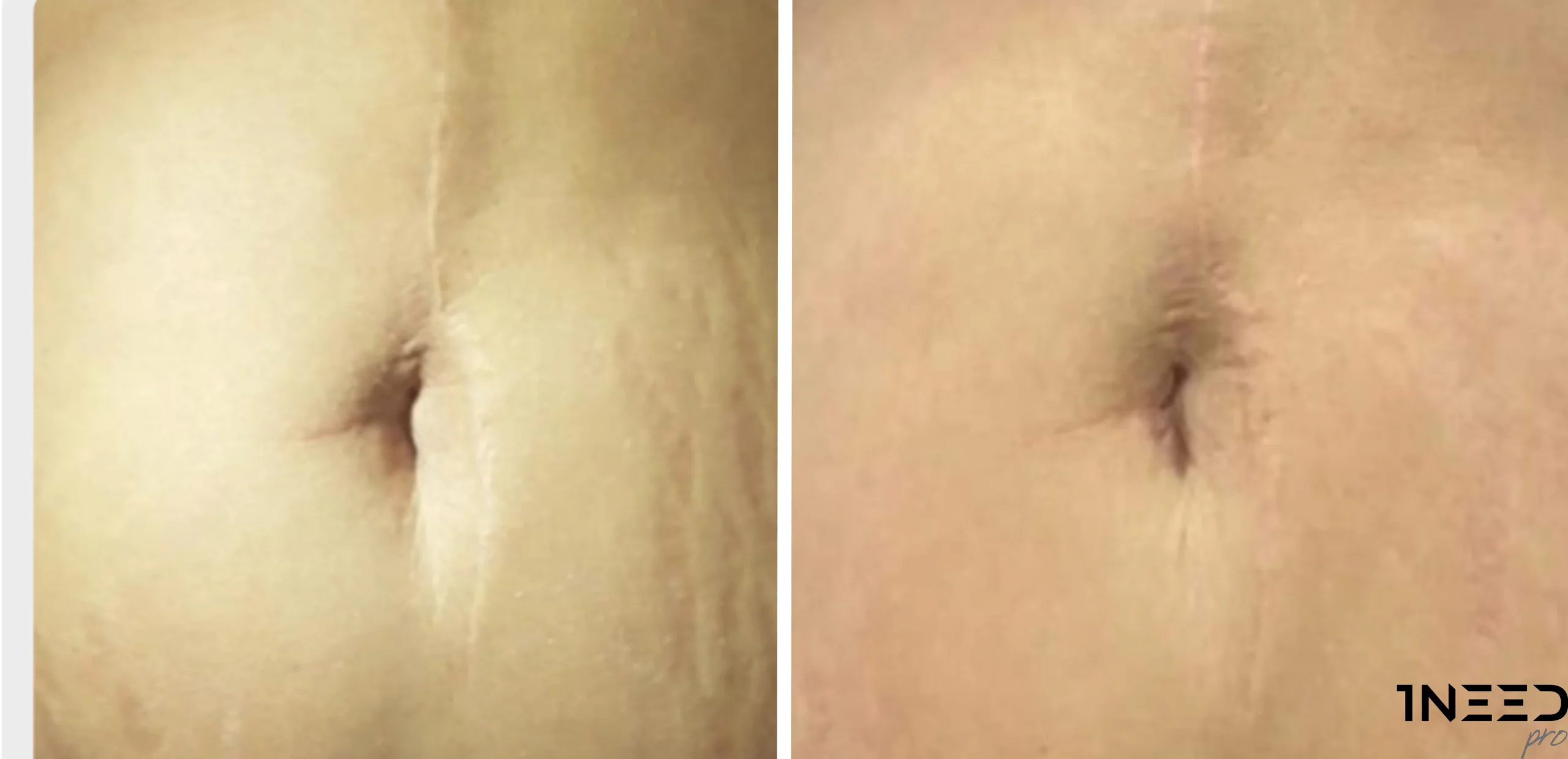 1needpro skin treatment
