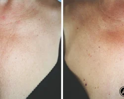 Before and After Biorepeel Treatment