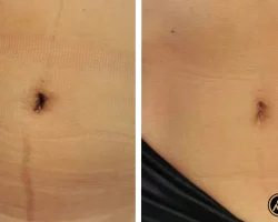 Before and After Biorepeel​