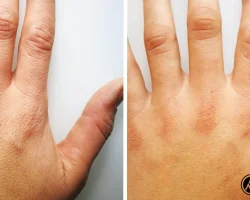 Biorepeel Before and After​