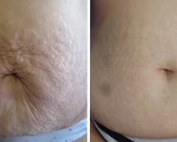 Fusion Meso Therapy Treatments