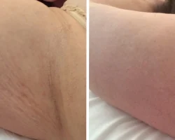 Meso Skin Treatment Cairns