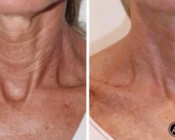 Biorepeel Aftercare​