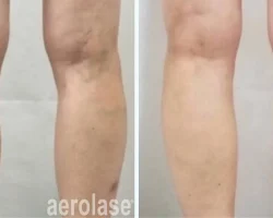 Leg Veins Treatment
