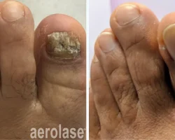 Nail fungus treatment