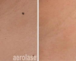 Skin tag treatments