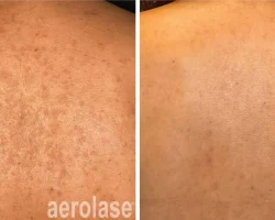Aerolase Hyperpigmentation Treatment
